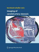 Imaging of Carotid Artery Stenosis