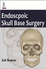 Minimal Access Skull Base Surgery