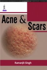 Acne & Scars