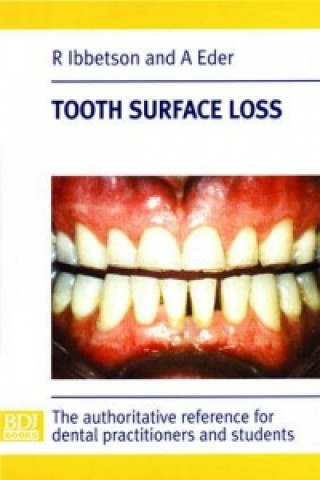 Tooth Surface Loss