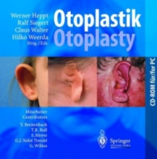 Otoplastik / Otoplasty