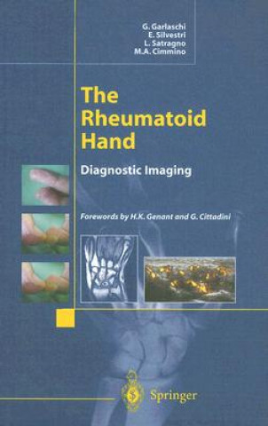 Rheumatoid Hand