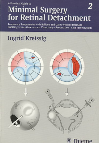 A   Practical Guide to Minimal Surgery for Retinal Detachment, Volume 2: Temporary Tamponades with Balloon and Gases Without Drainage, Buckling Versus