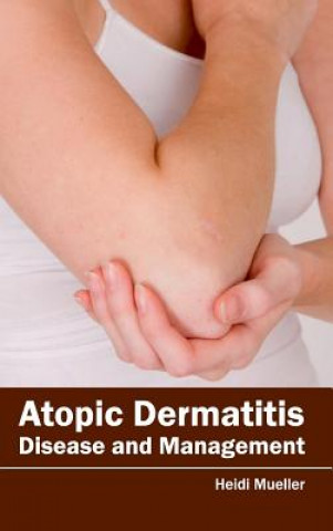 Atopic Dermatitis: Disease and Management
