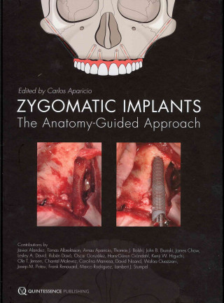 Zygomatic Implants: The Anatomy-Guided Approach