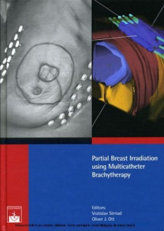 Partial Breast Irritation using Multicatheter Brachytherapy
