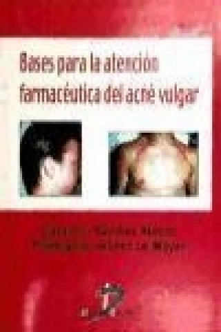 Bases para la atención farmacéutica del Acne Vulgar