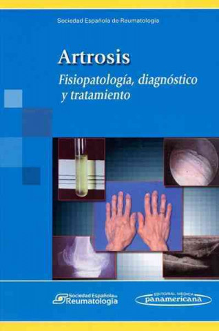 Artrosis. Fisiopatología, diagnóstico y tratamiento.