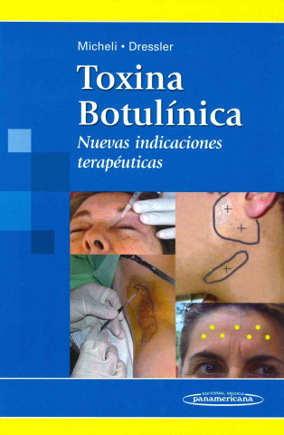 Toxina Botulínica. Nuevas indicaciones terapéuticas.
