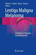 Lentigo Maligna Melanoma