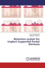 Retention system for Implant Supported Partial Dentures