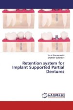 Retention system for Implant Supported Partial Dentures