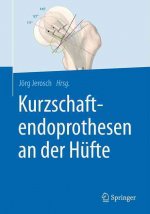 Kurzschaftendoprothesen an der Hufte