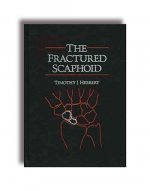 Fractured Scaphoid
