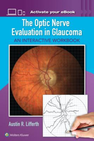 Optic Nerve Evaluation in Glaucoma