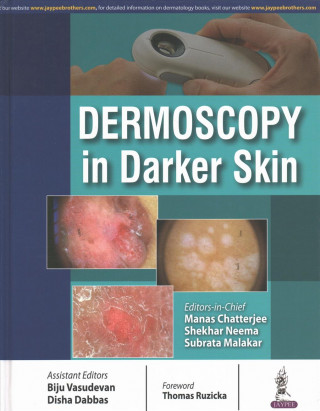 Dermoscopy in Darker Skin