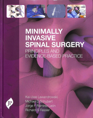 Minimally Invasive Spinal Surgery