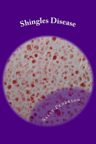 Shingles Disease: The Complete Guide