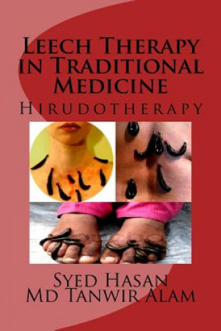 Leech Therapy in Traditional Medicine: Hirudotherapy
