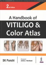 Handbook of Vitiligo & Color Atlas