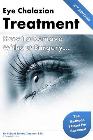 Eye Chalazion: How To Remove Without Surgery: My personal experience and the methods I used for success