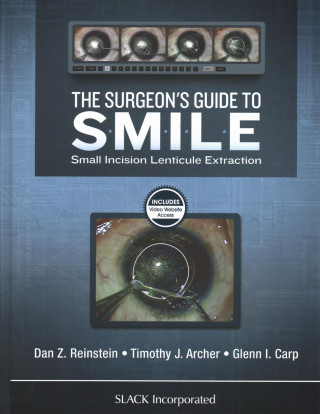 Surgeon's Guide to SMILE