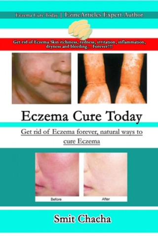 Eczema Cure Today - Get rid of Eczema forever natural ways to cure Eczema
