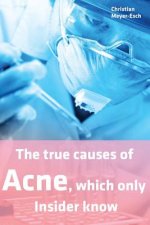 The true causes of Acne, which only Insider know