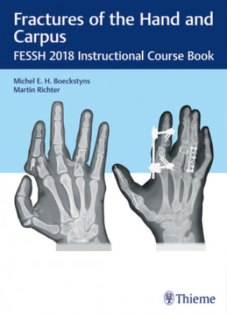 Fractures of the Hand and Carpus