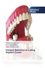 Cement Selection in Luting Implant Crown