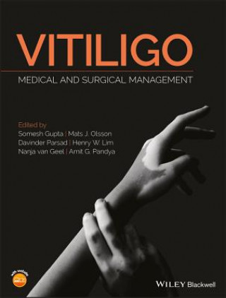 Vitiligo - Medical and Surgical Management