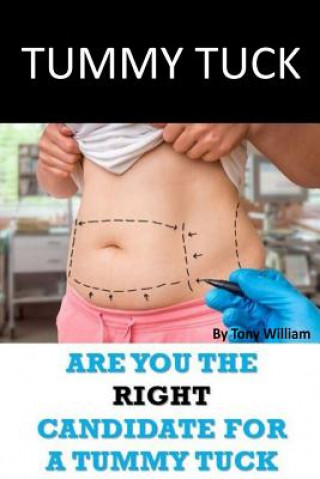Tummy Tuck: Are You The Right Candidate For A Tummy Tuck