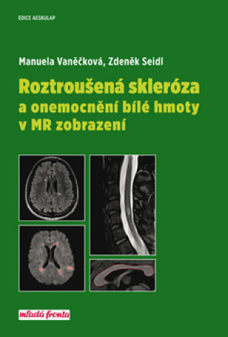 Roztroušená skleróza a onemocnění bílé hmoty v MR zobrazení