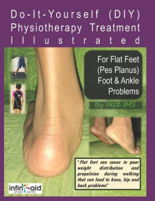 Physiotherapy Treatment Illustrated For Flat Feet (Pes Planus) Foot & Ankle Problems