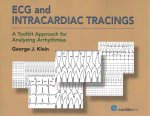 ECG and Intracardiac Tracings
