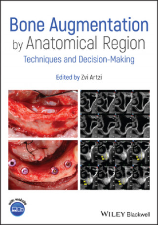 Bone Augmentation by Anatomical Region - Techniques and Decision-Making