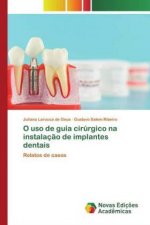 O uso de guia cirurgico na instalacao de implantes dentais
