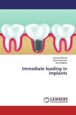 Immediate loading in implants