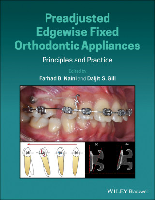 Preadjusted Edgewise Fixed Orthodontic Appliances - Principles and Practice