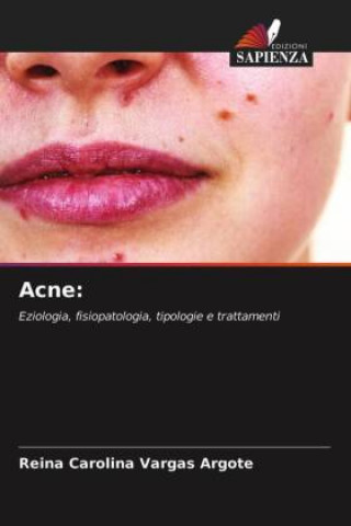 Acne