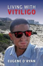 Living with Vitiligo