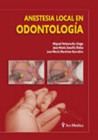 Anestesia local en odontolog­a