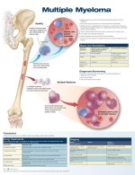 Multiple Myeloma Anatomical Chart