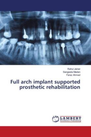 Full arch implant supported prosthetic rehabilitation
