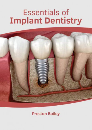 Essentials of Implant Dentistry