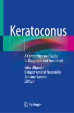 Keratoconus: A Comprehensive Guide to Diagnosis and Treatment