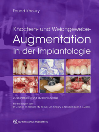 Knochen- und Weichgewebeaugmentation in der Implantologie
