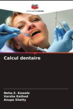 Calcul dentaire