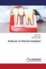 Failures in Dental Implant