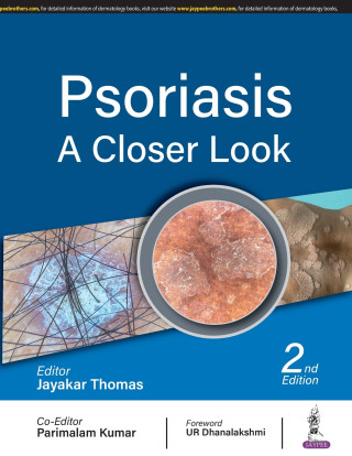 Psoriasis